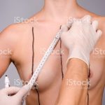 Doctor prepares for breast enhancement plastic surgery